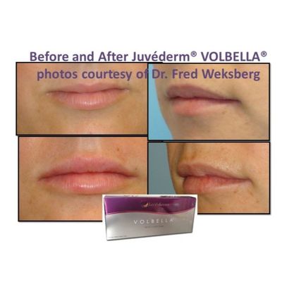 اسيد هايالورونيک ژل پر کننده صورت Juvederm پوست صاف و بدون نقص