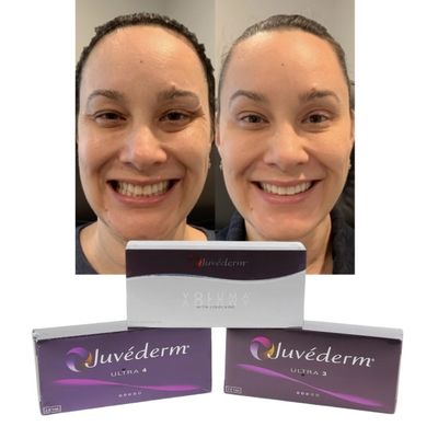 Juvederm Fillers Hyaluronic Acid Cross Linked Injection Juvederm Fillers Hyaluronic Acid Hyaluronic Acid Hyaluronic Acid Juvederm Fillers Hyaluronic Acid Hyaluronic Acid Hyaluronic Acid Hyaluronic Acid Hyaluronic Acid Hyaluronic Acid Hyaluronic Acid Hyaluronic Acid Hyaluronic Acid Hyaluronic Acid Hyaluronic Acid Hyaluronic Acid Hyaluronic Acid Hyaluronic Acid Hyaluronic Acid Hyaluronic Acid Hyaluronic Acid Hyaluronic Acid Hyaluronic Acid Hyaluronic Acid Hyaluronic Acid Hyaluronic Acid Hyaluronic