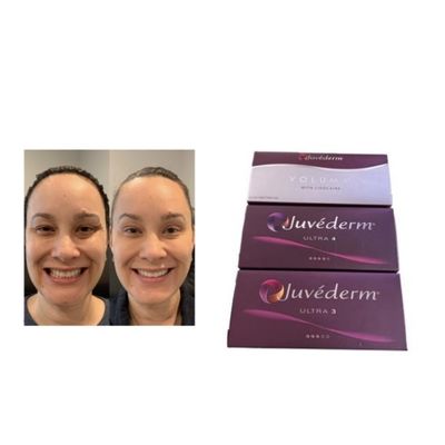 HA Juvederm پرکننده پوستی متقاطع Ultra3 Ultra4 حجم شرایط نگهداری از یخ زدن اجتناب کنید ژل تزریقی برای بازسازی حجم صورت