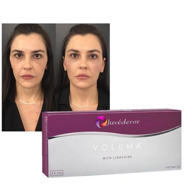 ژل پرکننده پوست اسید هیالورونیک Juvederm لب ها گونه های جوانسازی فرمول تقویت کننده